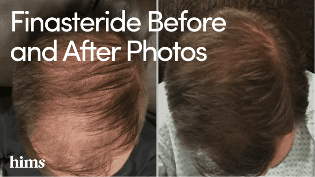 Finasteride Results: Finasteride Before and After Photos